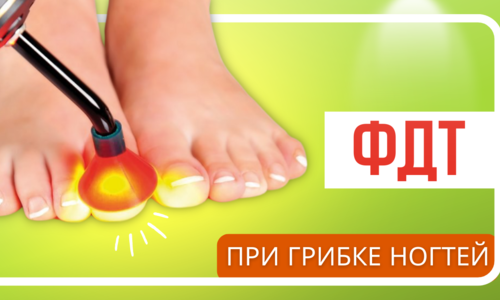Фотодинамическая терапия (ФДТ) грибка кожи